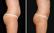El Facial de las mujeres/los ácidos grasos de la cavitación de Lipo del cuerpo/del brazo trabaja a máquina el vacío ultrasónico RF fraccionario