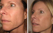 El Facial de las mujeres/los ácidos grasos de la cavitación de Lipo del cuerpo/del brazo trabaja a máquina el vacío ultrasónico RF fraccionario