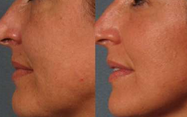 El Facial de las mujeres/los ácidos grasos de la cavitación de Lipo del cuerpo/del brazo trabaja a máquina el vacío ultrasónico RF fraccionario