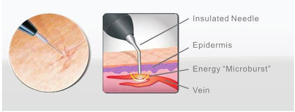 Inmediatamente máquina del tratamiento del laser de las varices del retiro de la vena de la araña del resultado/instrumentos quirúrgicos vasculares